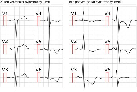 lv hypertrophy on ecg|lv hypertrophy ecg criteria.